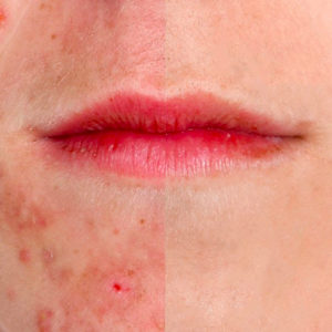 Curare l’acne senza farmaci