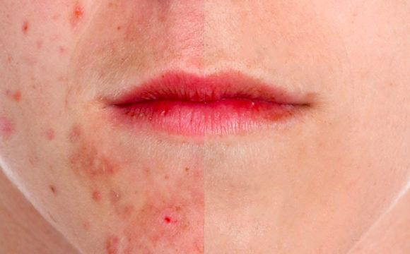 Curare l’acne senza farmaci