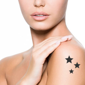Rimozione Tatuaggi